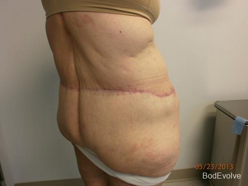 Patient 7 - Cosmetic Surgery After Massive Weight Loss -  After 5