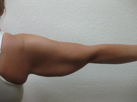 Arm Lift Surgery - Patient 1 - Before Image 4