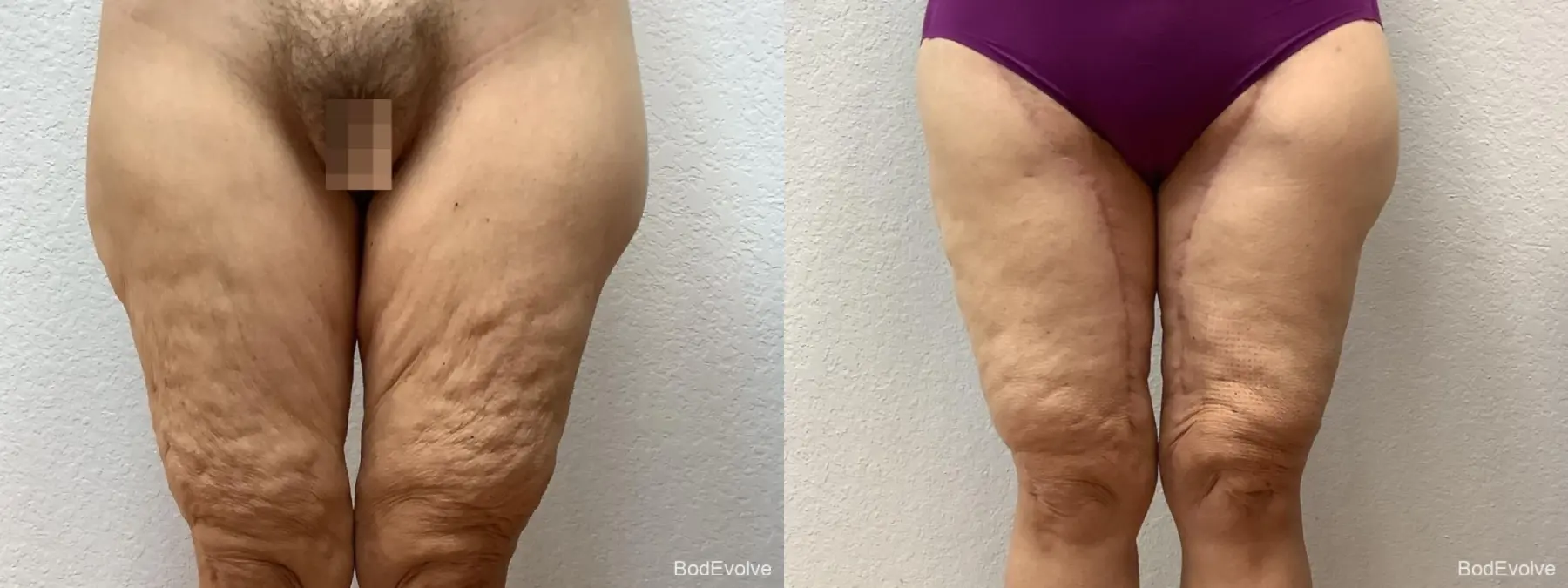 Thigh Lift: Patient 3 - Before and After  