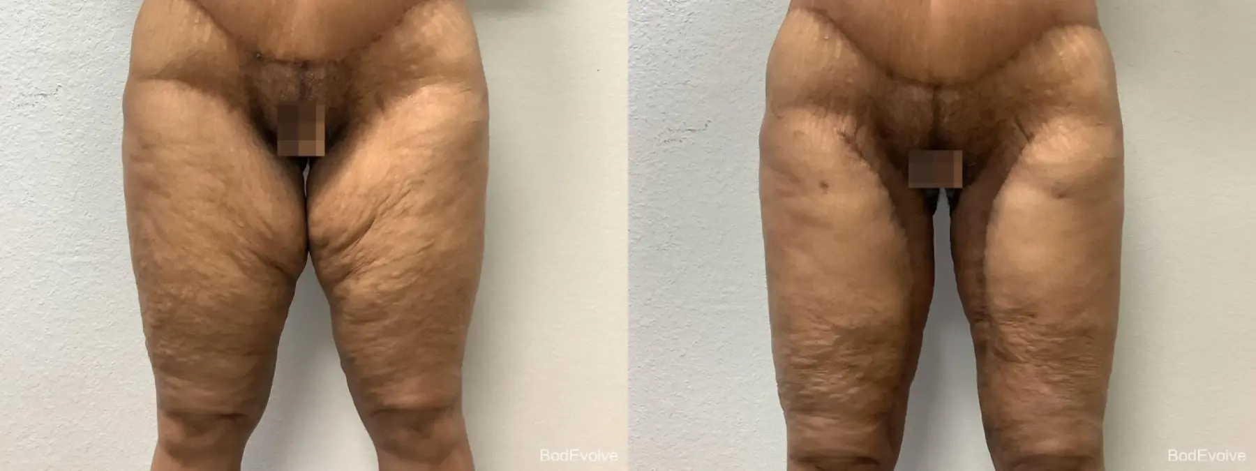 Thigh Lift: Patient 1 - Before and After  