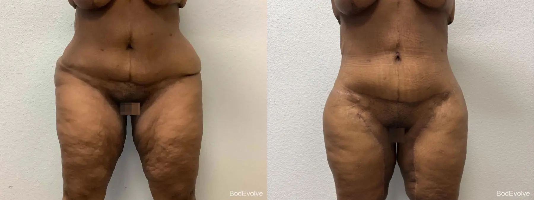 Thigh Lift: Patient 2 - Before and After  