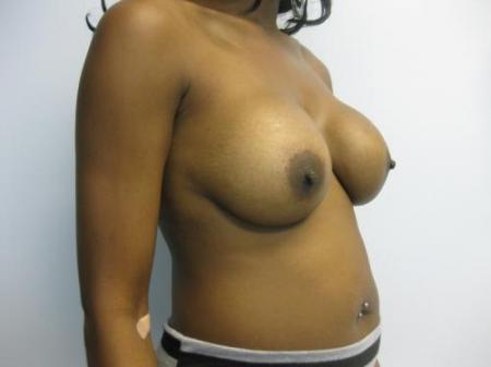 Breast Implant Revision - Before Image 4
