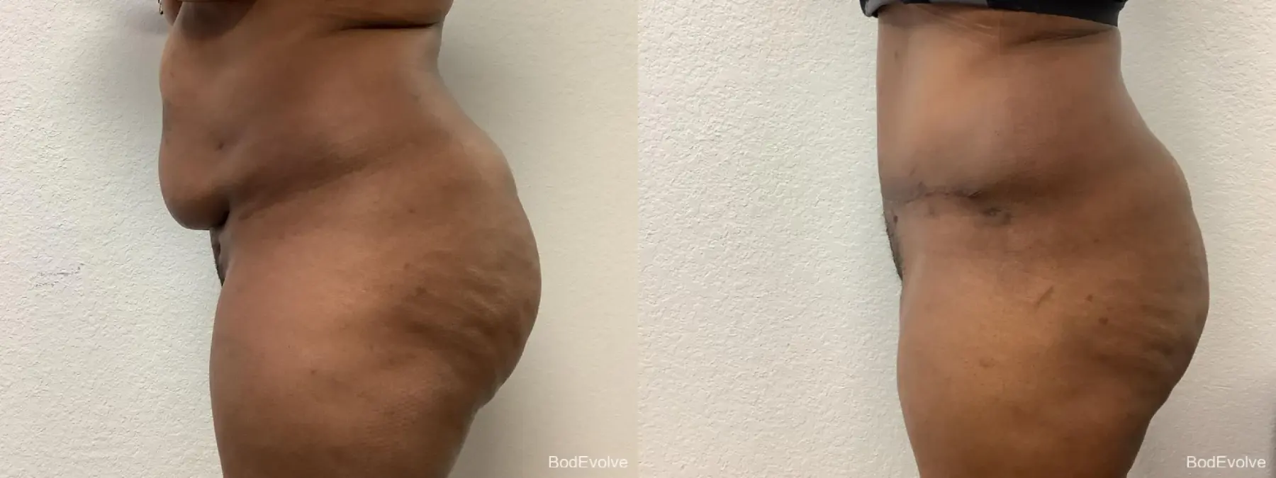 Tummy Tuck: Patient 3 - Before and After 4