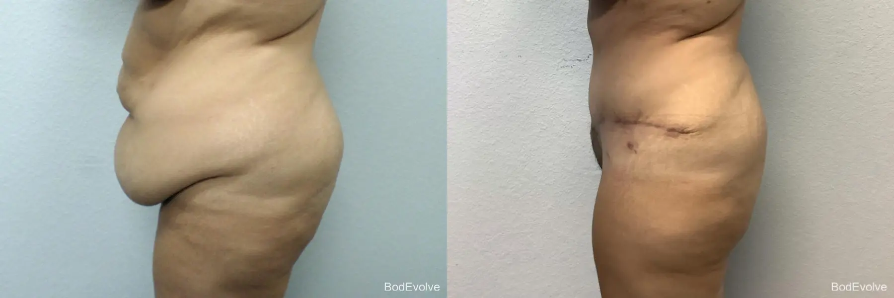 Tummy Tuck: Patient 5 - Before and After 2