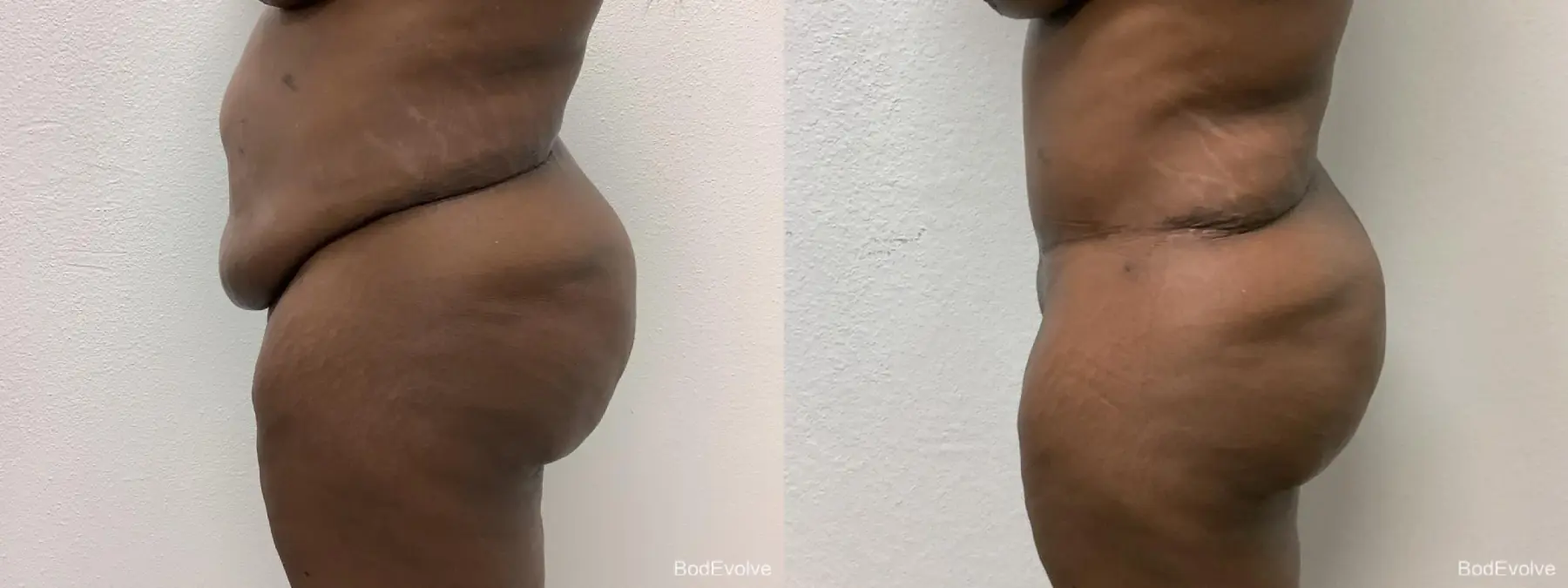 Tummy Tuck: Patient 2 - Before and After 5