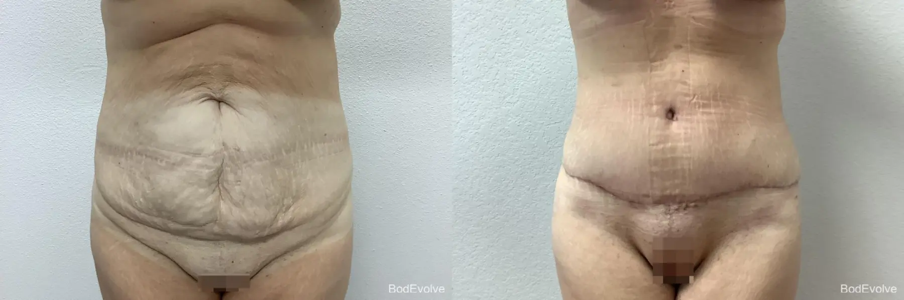 Tummy Tuck: Patient 8 - Before and After  