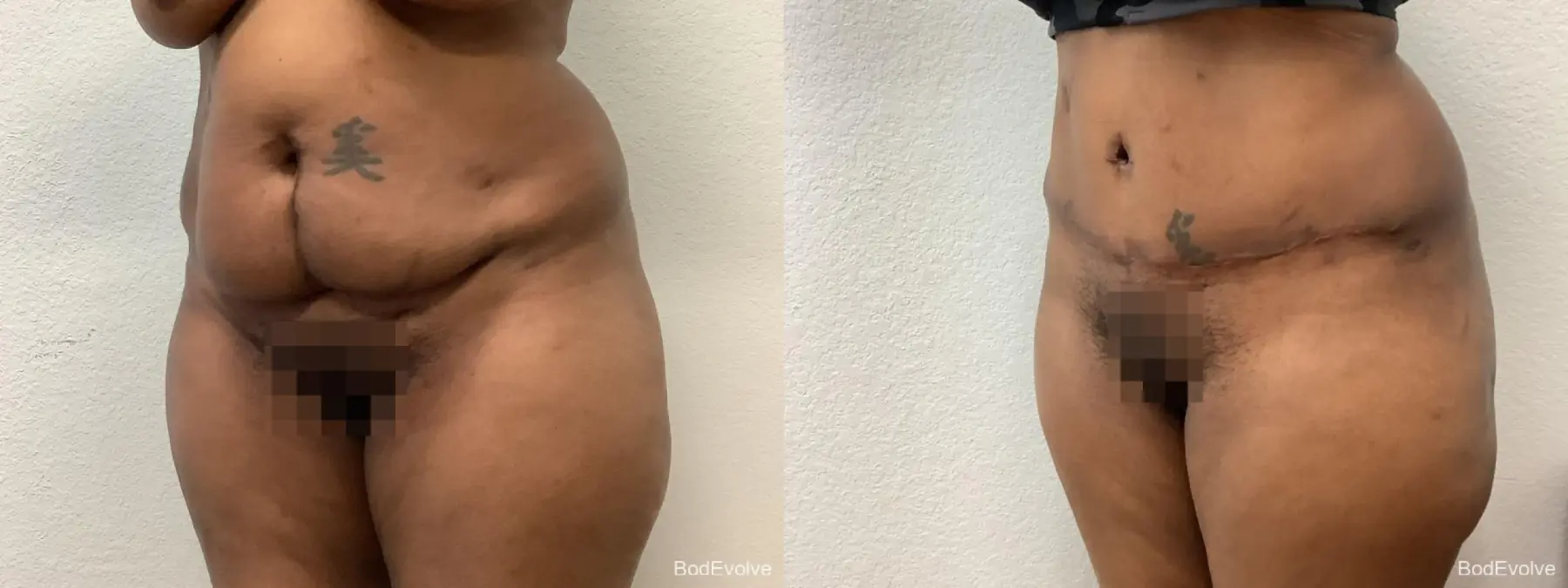 Tummy Tuck: Patient 3 - Before and After 5