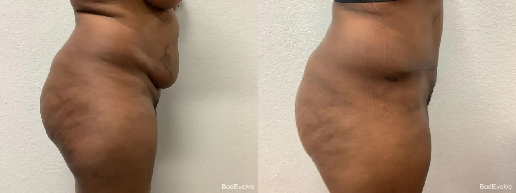 Tummy Tuck: Patient 3 - Before and After 3
