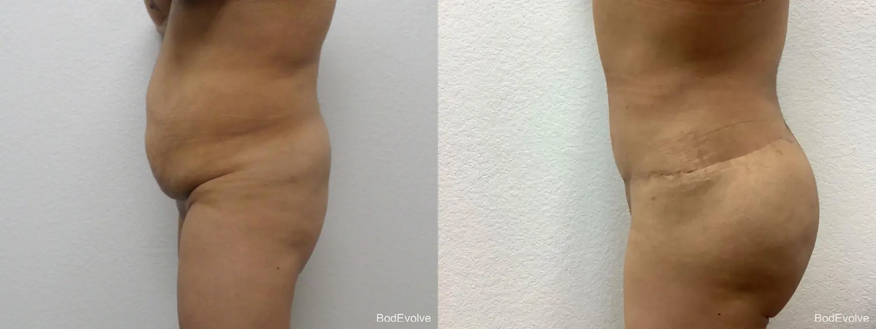 Tummy Tuck: Patient 7 - Before and After 2