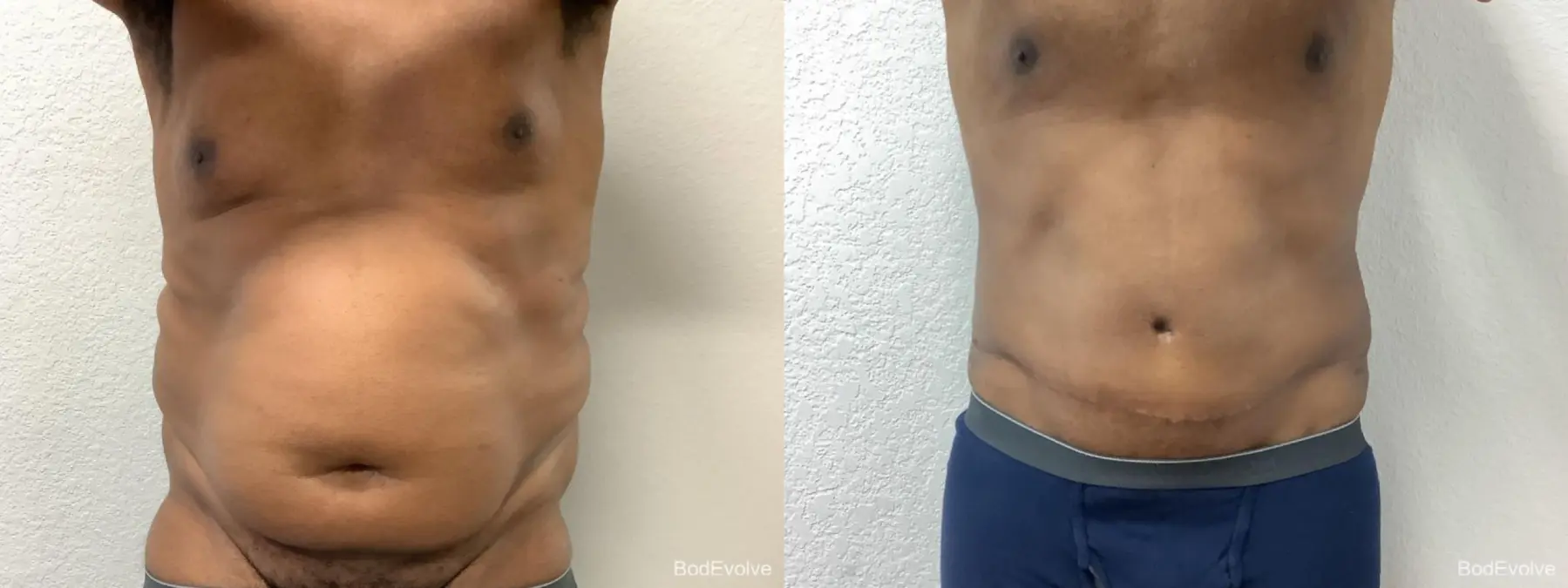 Tummy Tuck: Patient 6 - Before and After  
