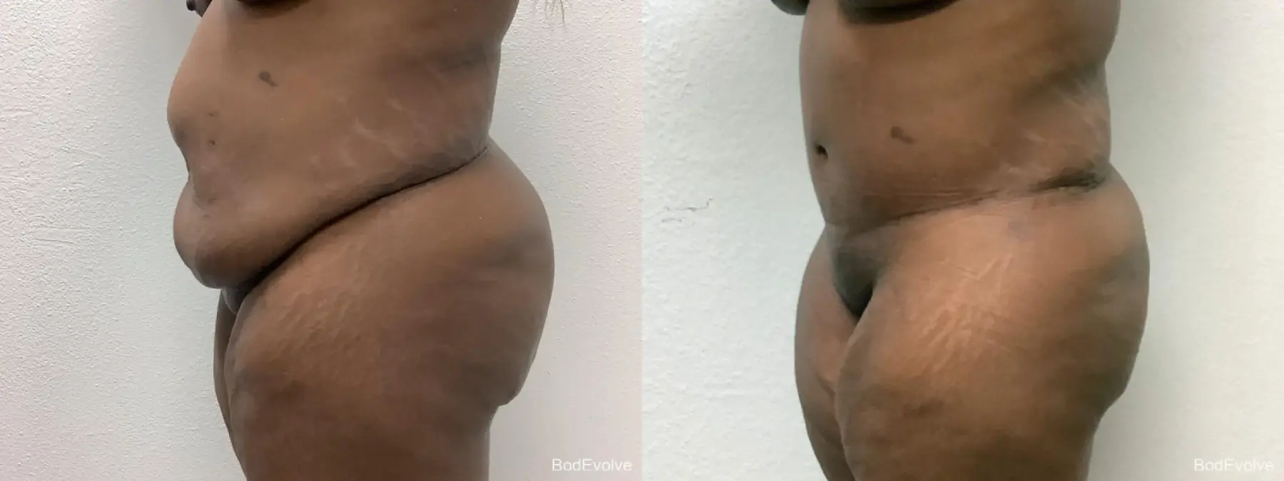 Tummy Tuck: Patient 2 - Before and After 4