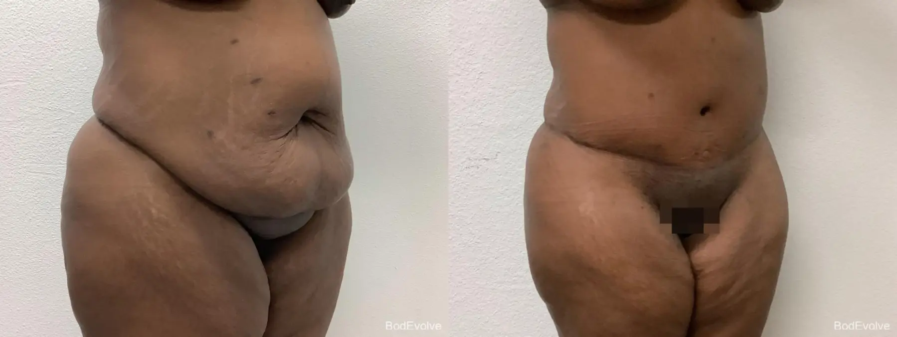 Tummy Tuck: Patient 2 - Before and After 2