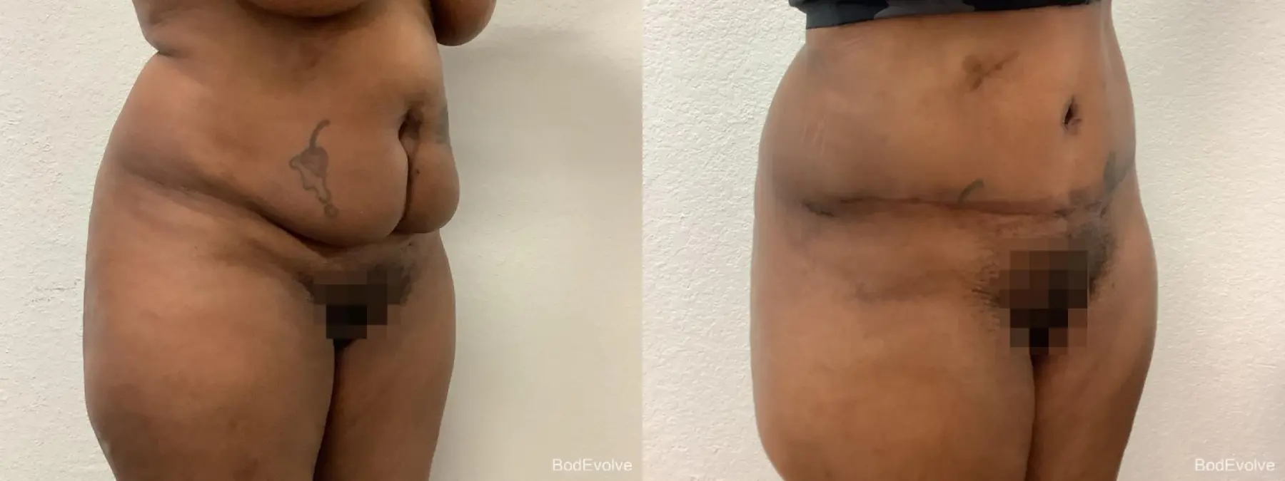 Tummy Tuck: Patient 3 - Before and After 2