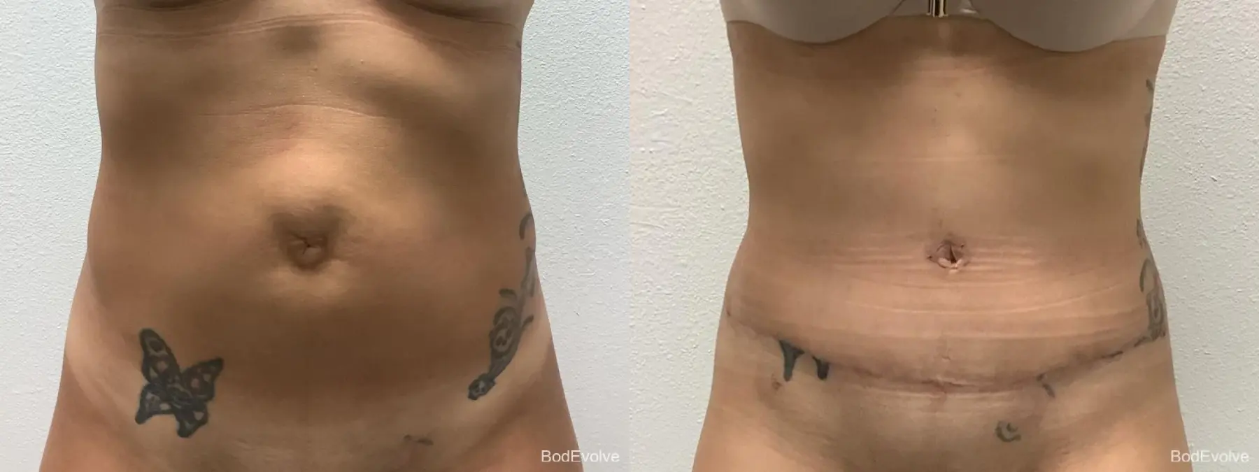 Tummy Tuck: Patient 8 - Before and After  