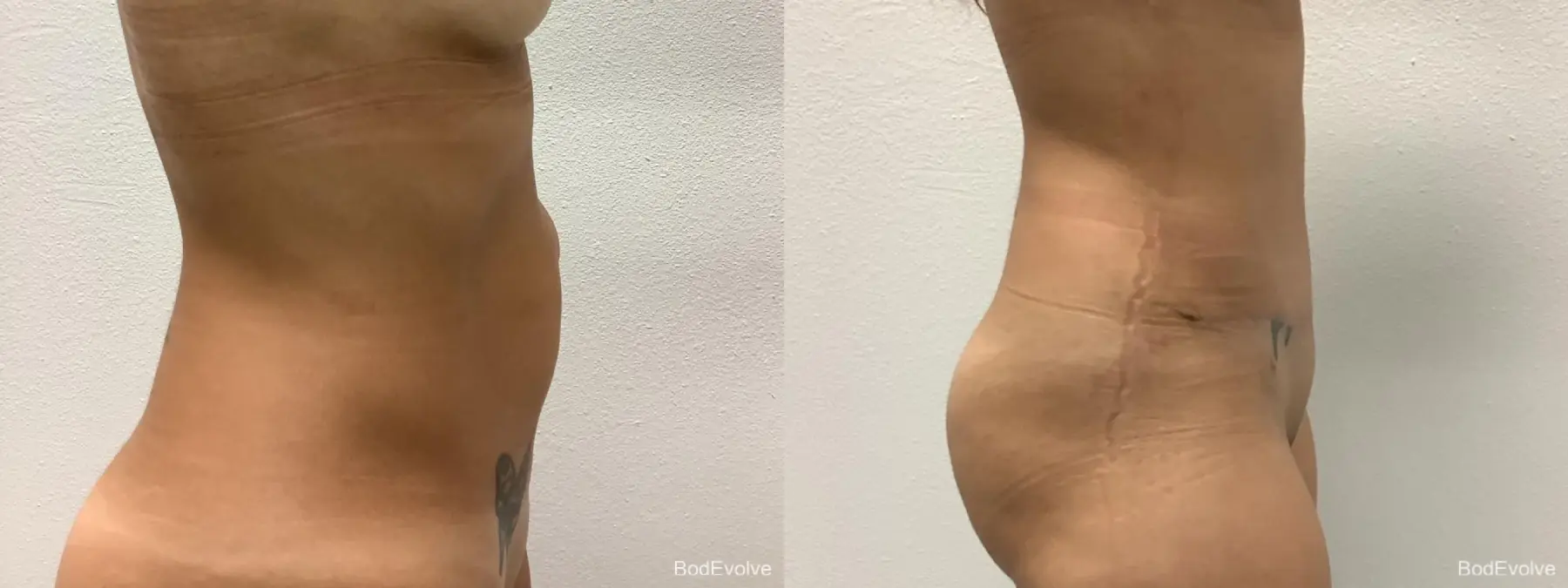 Tummy Tuck: Patient 9 - Before and After 4