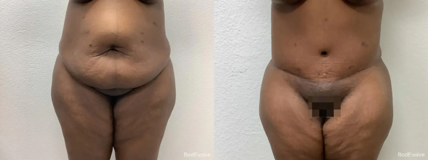 Tummy Tuck: Patient 2 - Before and After 1