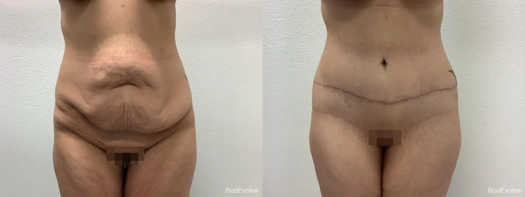 Tummy Tuck: Patient 1 - Before and After  