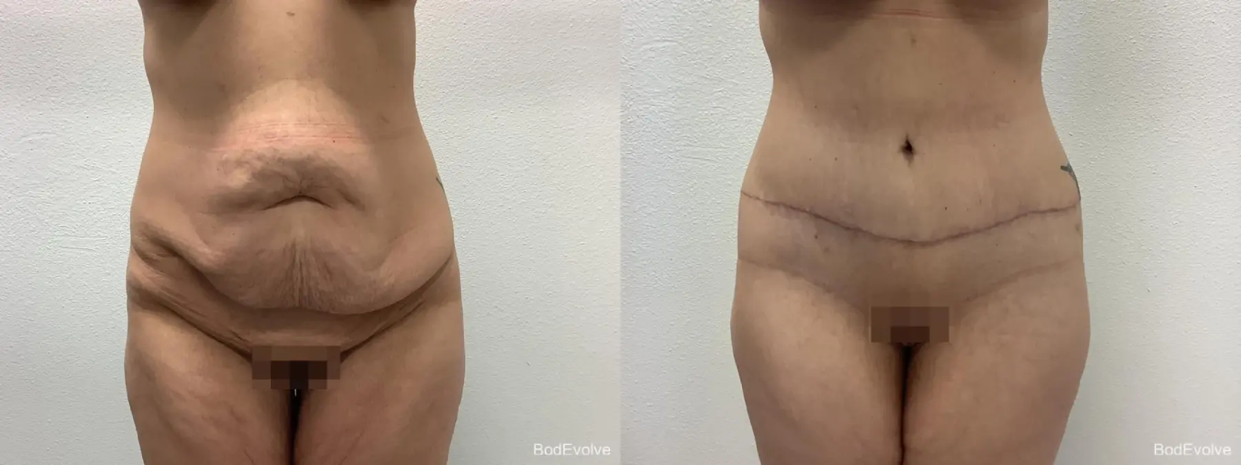 Tummy Tuck: Patient 1 - Before and After 1