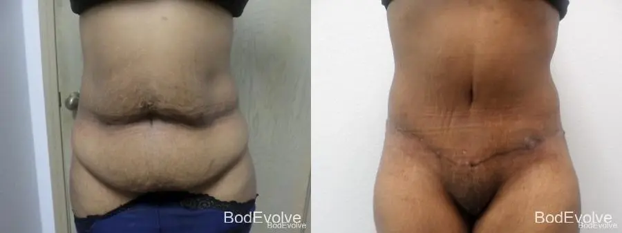 Tummy Tuck: Patient 33 - Before and After 1