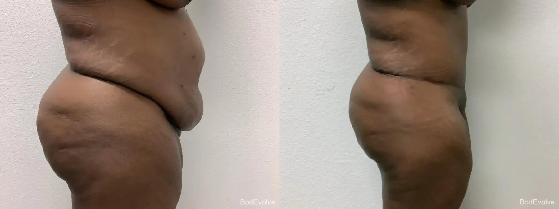 Tummy Tuck: Patient 2 - Before and After 3