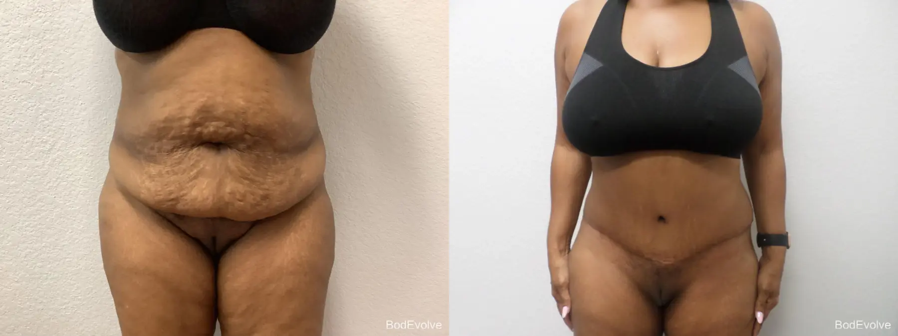 Tummy Tuck: Patient 10 - Before and After 1