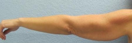 Arm Lift Surgery - Patient 3 - Before Image 3