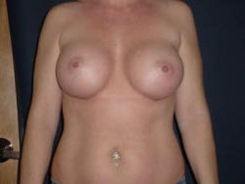 Breast Augmentation - Patient 16 -  After 1
