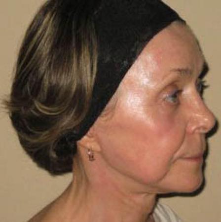 Facelift - Patient 2 - After Image 2