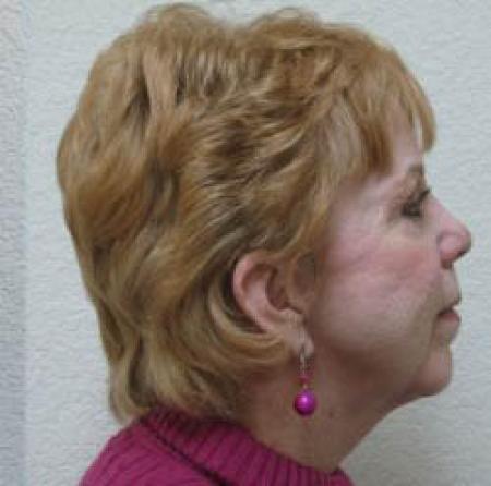 Facelift - Patient 1 - Before Image 5