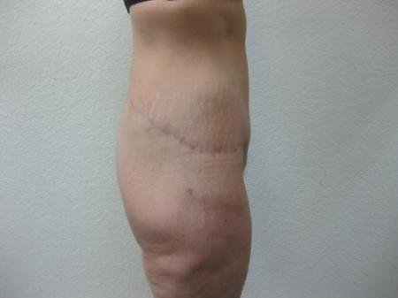 Body Lift - Patient 8 - After Image 2