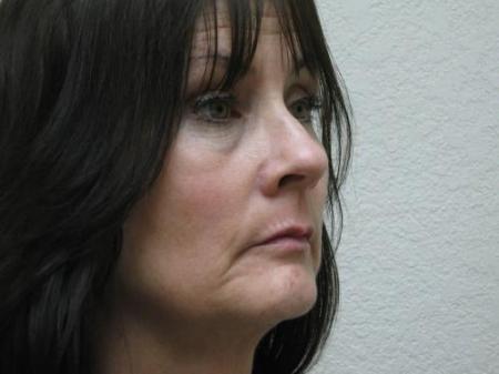 Lip Augmentation - Patient 2 - Before Image 2