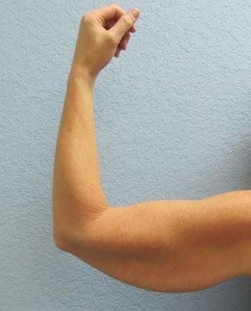 Arm Lift Surgery - Patient 3 - Before Image 6