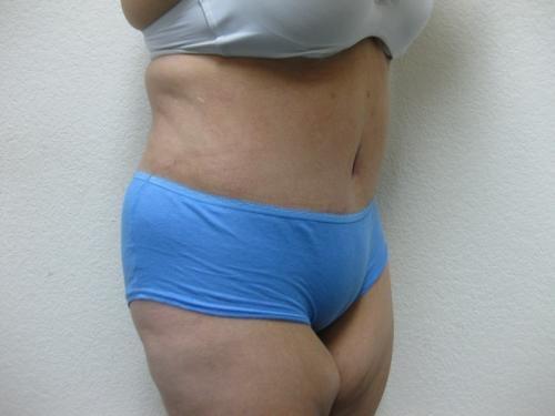 Patient 10 - Cosmetic Surgery After Massive Weight Loss -  After 4