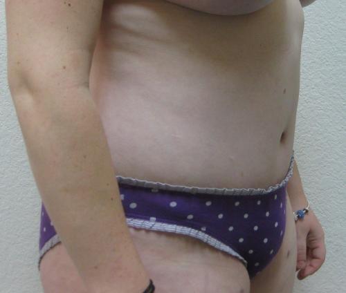 Tummy Tuck - Patient 15 -  After 2