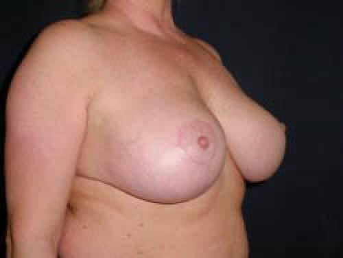 Breast Augmentation with Lift - Patient 8 -  After 2