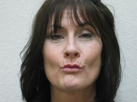 Lip Augmentation - Patient 2 - Before Image 4