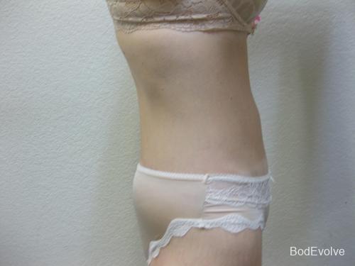 Body Lift - Patient 2 - After 3