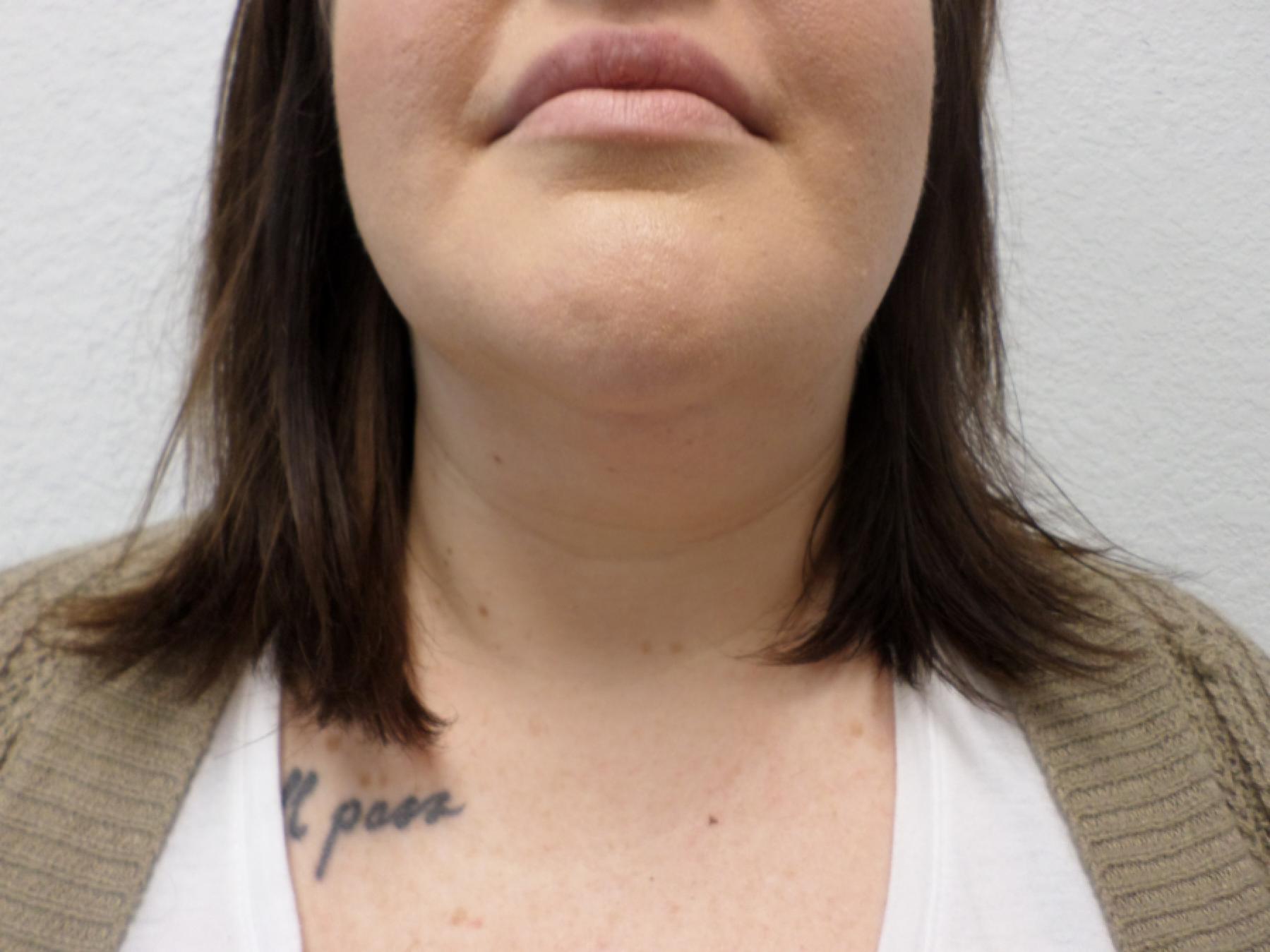 Liposuction: Patient 17 - After 1