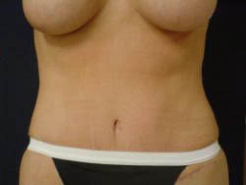 Tummy Tuck - Patient 7 - After 