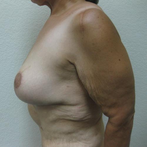 Patient 22 - Cosmetic Surgery After Massive Weight Loss -  After 4