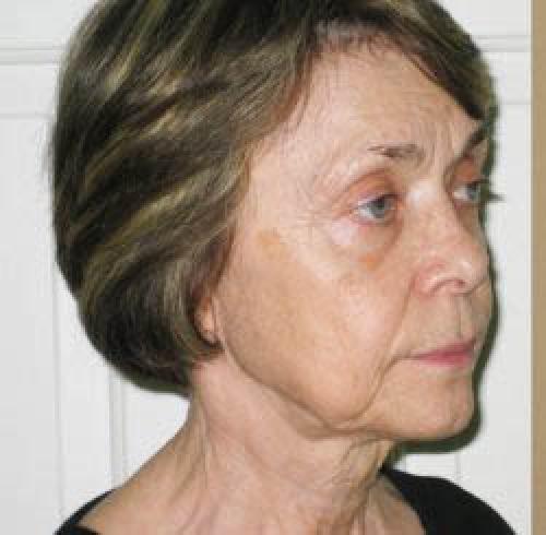 Laser Skin Resurfacing - Before and After 4
