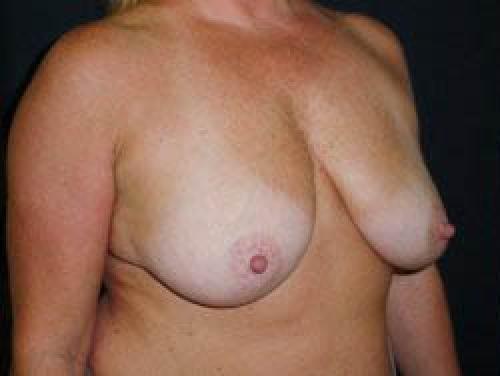 Breast Augmentation with Lift - Patient 8 - Before 2