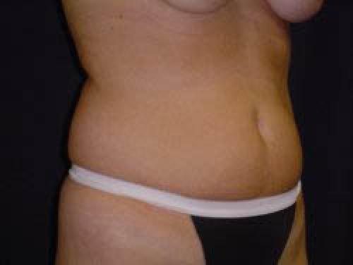 Liposuction - Patient 8 - Before 4