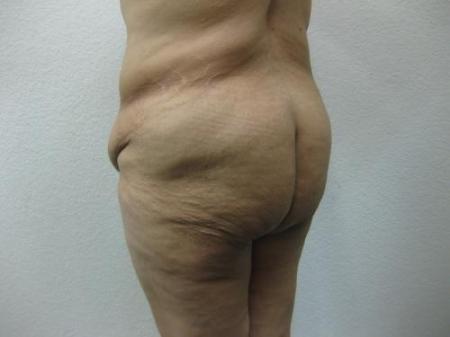 Body Lift - Patient 7 - Before Image 5