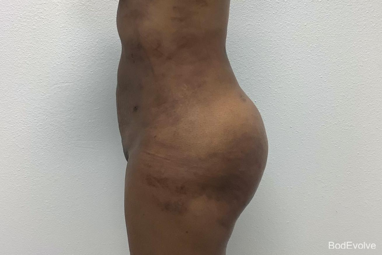 Brazilian Butt Lift: Patient 3 - After 2