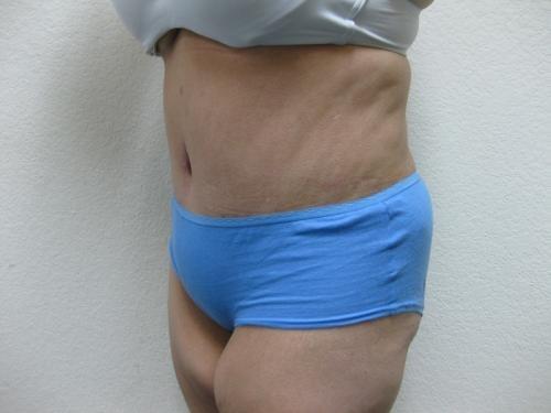 Patient 10 - Cosmetic Surgery After Massive Weight Loss -  After 2