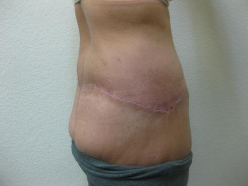 Patient 25 - Cosmetic Surgery After Massive Weight Loss -  After 6