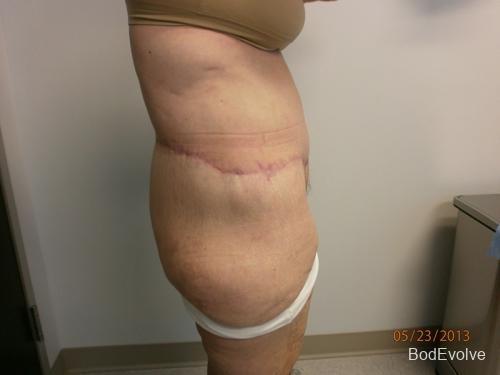 Patient 7 - Cosmetic Surgery After Massive Weight Loss -  After 6