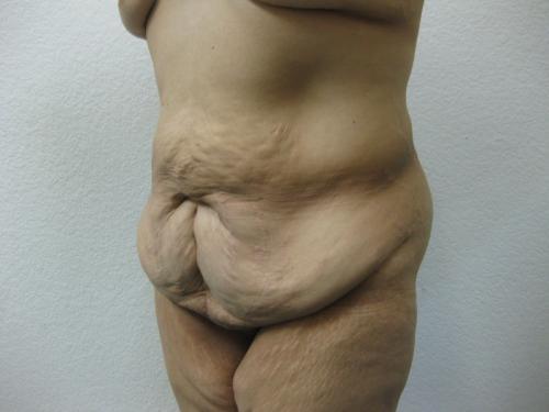 Body Lift - Patient 7 - Before and After 6