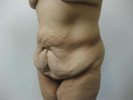 Body Lift - Patient 7 - Before Image 6